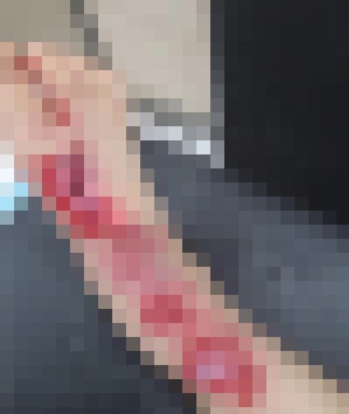 경기 시흥시 목감동 아파트 단지에서 발생한 롯데마트 배송차량 사고로 다친 만 4세 아동의 오른발. 사고 당시 1톤 탑차 앞바퀴에 발등이 깔려 심한 출혈과 상해를 입었다. (보배드림 피해 가족 게시물 캡처)